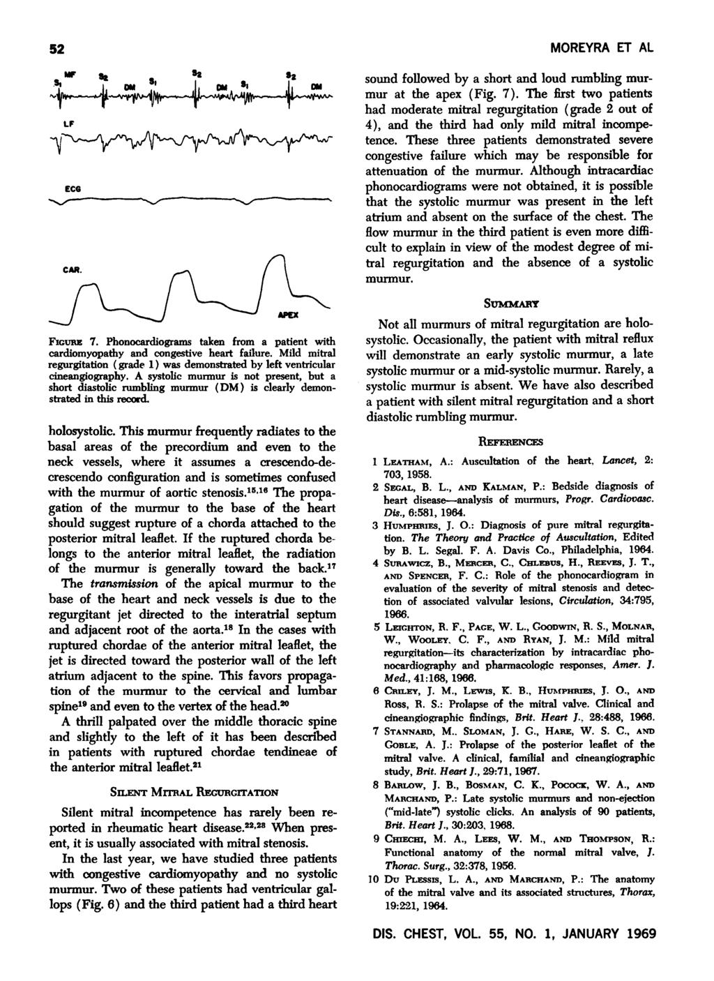 52.. lie ~H,~IV-1I\\o,."'--"'-~~I~.-.JU.-~ LF Eee...------'-""""""-------'-/""""-----... FIGURE 7. Phonocardiograms taken from a patient with cardiomyopathy and congestive heart failure.