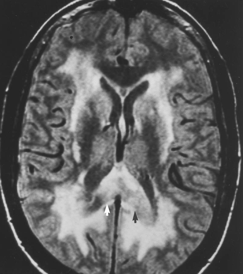 Note primary lymphoma that crosses midline through corpus callosum. High-grade gliomas and radiation necrosis may have similar appearance.