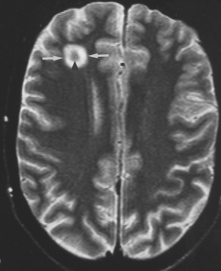 erebral toxoplasmosis may show identical appearance, except that toxoplasmosis usually will not have hypointense center on T2-weighted images.