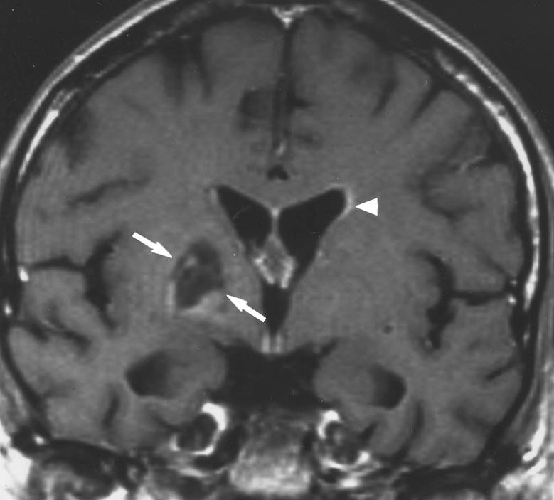 Note atypical lymphoma in immunocompromised patient presented as nonenhancing low-density lesion in right basal ganglia on T, initially