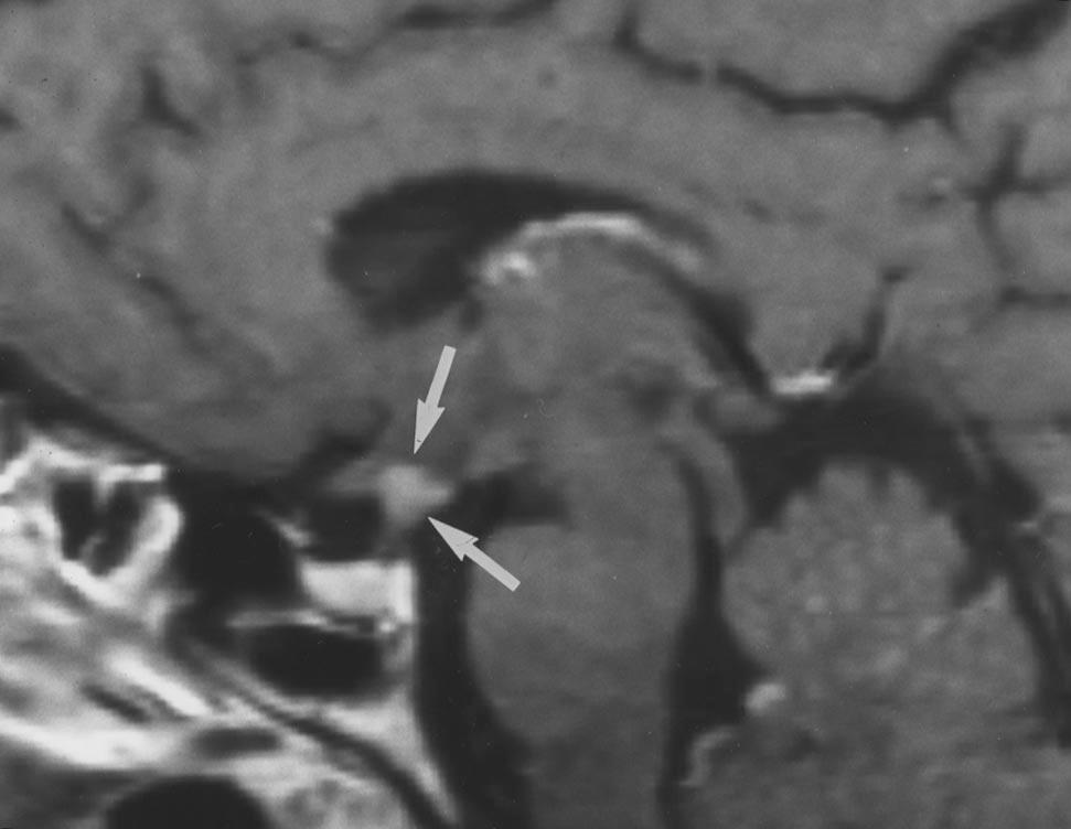 , Sagittal gadolinium-enhanced T1-weighted MR image shows markedly enhancing midline mass (arrows). Upper aspect of pituitary stalk also appears to be involved. Fig. 13.