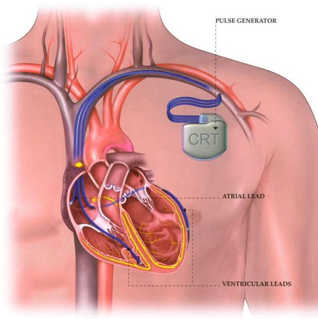 About this booklet The purpose of this booklet is to provide information about Cardiac Resynchronisation Therapy using a Pacemaker and what you should expect during the course of your treatment.