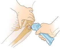 Slide your thumb up the anterior shaft of the humerus until you feel the greater tubercle, this is the surgical neck.