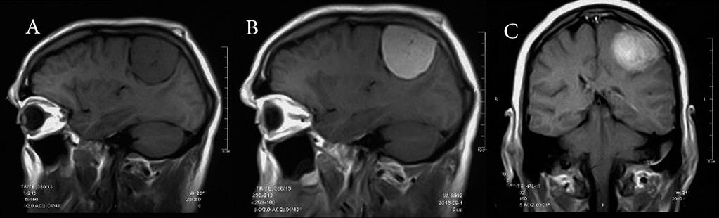 JOURNAL OF NEUROLOGY AND NEUROSCIENCE Figure 1 Pre-operative: MRI of the Brain showing the mass studied Figure 2 Post-operative: Magnetic resonance imaging of the brain reveals,