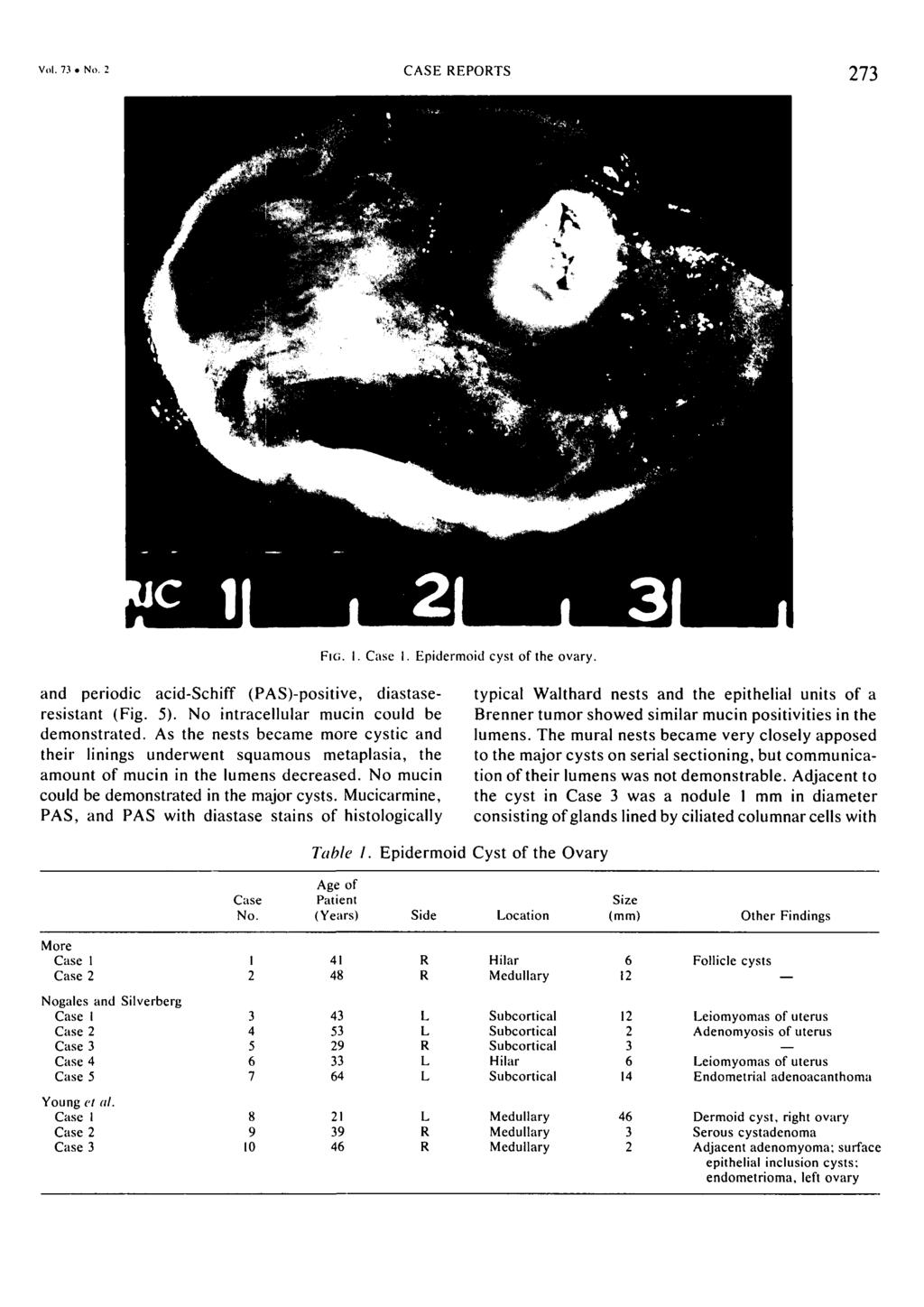 Vol. 7 No. CASE EPOTS 7 FIG. I. Case I. Epidermoid cyst of the ovary. and periodic acid-schiff (PAS)-positive, diastaseresistant (Fig. 5). No intracellular mucin could be demonstrated.