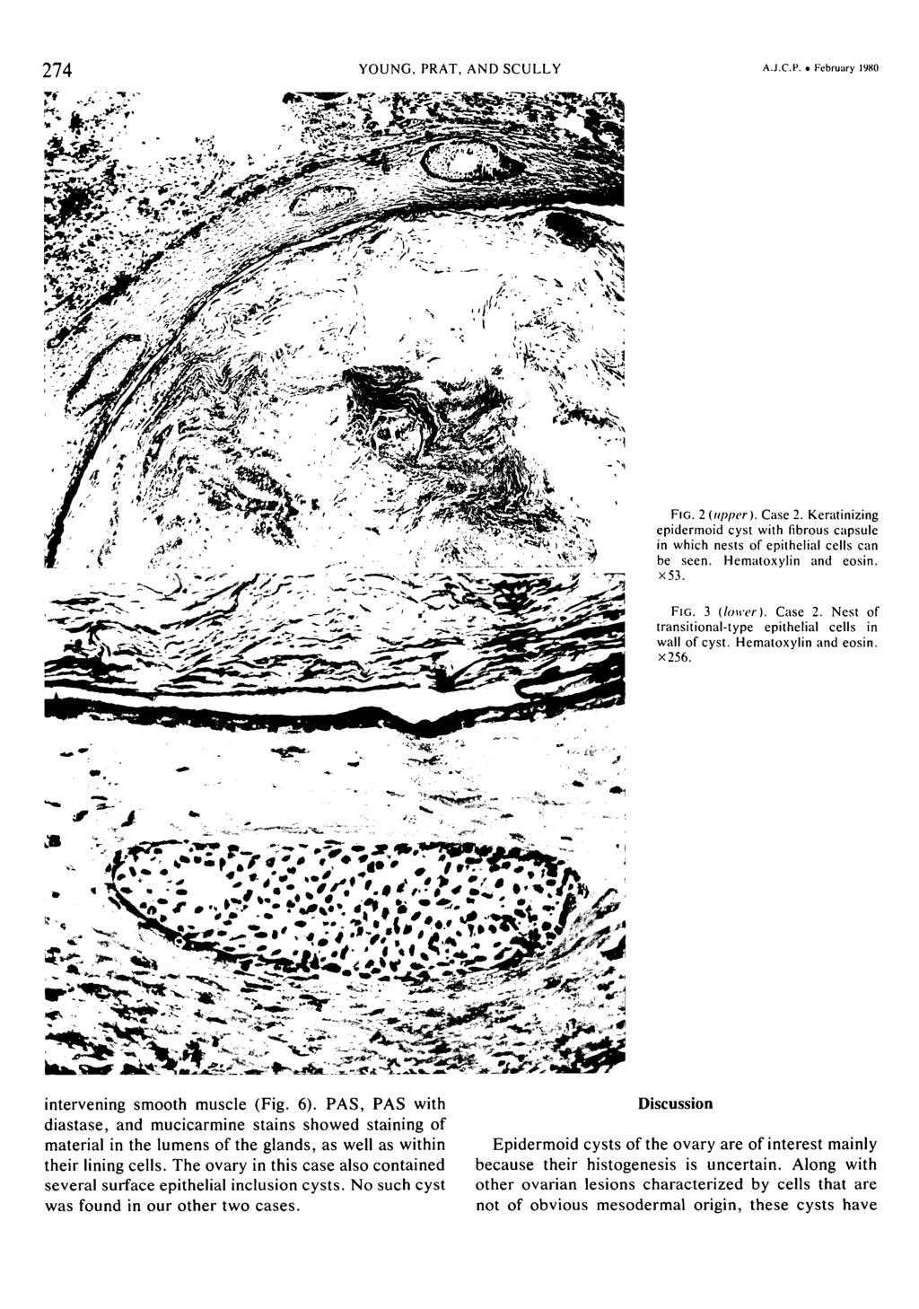 74 YOUNG. PAT, AND SCUY A.J.C.I'. February 1980 FIG. {upper).. Keratinizing epidermoid cyst with fibrous capsule in which nests of epithelial cells can be seen. Hematoxylin and eosin. X5. FIG. {lower).
