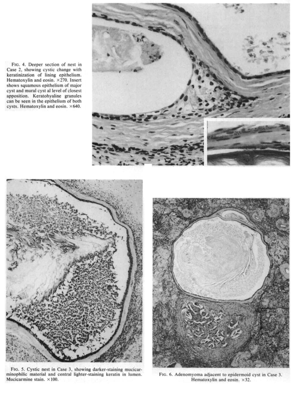 Vol. 7 No. CASE EPOTS 75 FIG. 4. Deeper section of nest in, showing cystic change with keratinization of lining epithelium. Hematoxylin and eosin. x70.