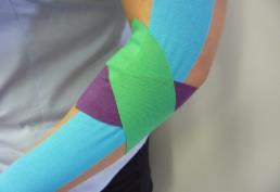 The second and third strips of tape are applied as a space correction for the area of pain over or around the
