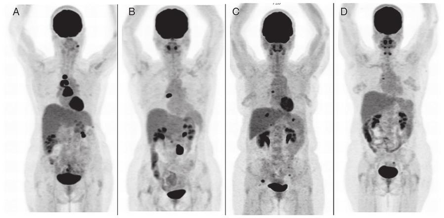 ONCOLOGY LETTERS 5: 593-597, 2013 595 Figure 1. Patients with CA-125 levels within normal range with positive PET/CT scan showing supra-diaphragmatic lymph node and pelvic/abdominal metastases.