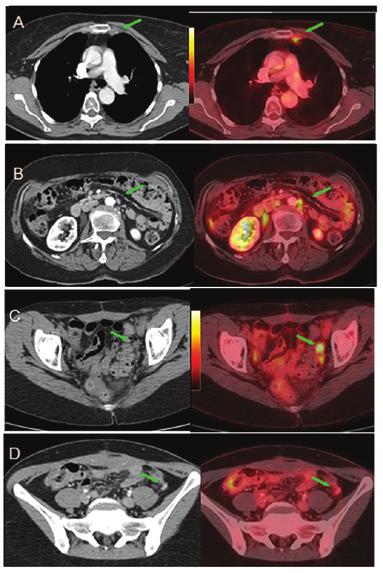 596 DRAGOSAVAC et al: FDG PET/CT RESTAGING OF OVARIAN CANCER Table III. Distribution of metastases found on PET/CT.