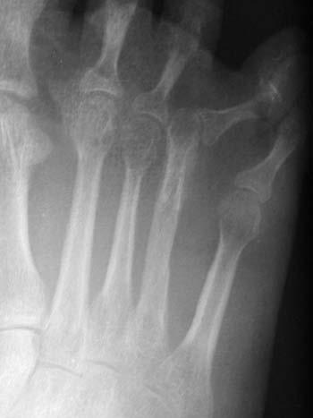 At 6 months postoperative, significant subluxation of the metatarsophalangeal joint is noted and the fourth toe is deviated laterally onto the