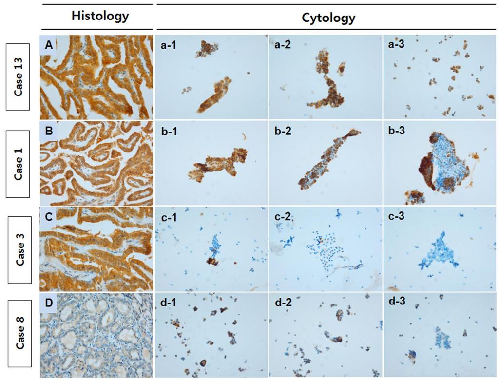18 Fig. 1. The extent of VE1 immunoexpression in representative cases evaluated histologically (capital letters) and cytologically (lowercase letters).