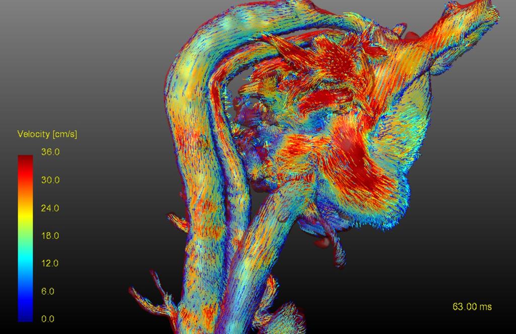Fig. 3: 4D flow reconstruction of the aorta in a patient with a chronic aortic dissection illustrating true and false lumen