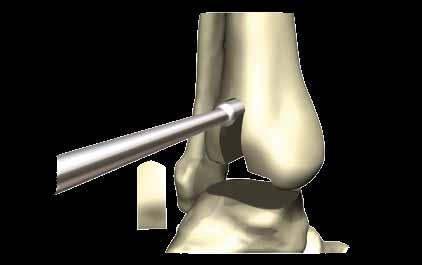 Tibial window removal The tibial window is removed by using the curved osteotome as a punch. Tapping the proximal end of the prepared tibial window allows the bone to be removed in one piece.