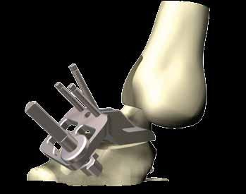 Step 10. Talus sizing and centring It is important to ensure the talus component sits centrally beneath the tibia in order to restore the natural biomechanics of the ankle.