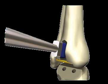 The thickness of the mobile insert is defined by the condition of the ankle in relation to the soft tissue and ligaments, ensuring joint stability.
