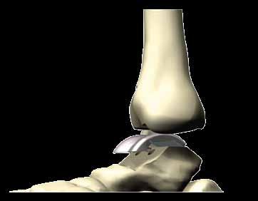 reconstruction. With the trials in place, the ankle joint must have a good range of movement. Plantar-flexion should be up to 45 and dorsi-flexion should be up to 20.