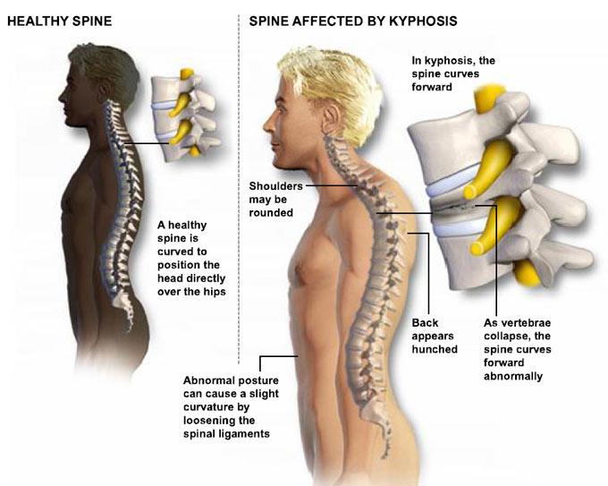 Kyphotic Postural Analysis An intervertebral collapse occurs at the disc and causes a loss of normal height.