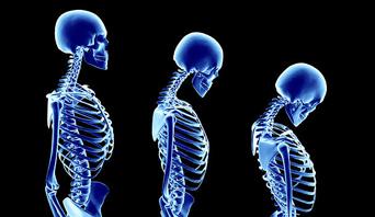 Kyphosis will continue to as the hump begins to worsen with ages.