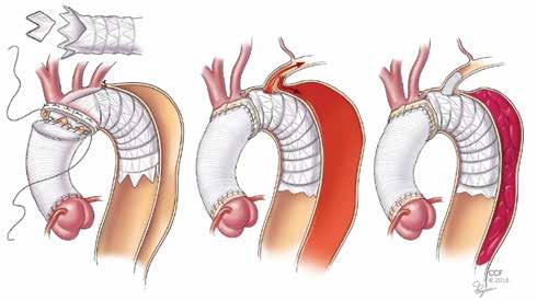 Emergency Ascending Aorta and Aortic Arch Open Surgery and In-Hospital Mortality 212 216 In-hospital mortality (%) 3 3 2 1 2 1 Cleveland Clinic surgeons performed 183 emergency open repairs of the
