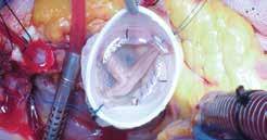 Valve-Preserving Operations Cleveland Clinic cardio-aortic surgeons are among the most experienced in the world at performing valve-preserving aortic root aneurysm repairs (modified David s valve