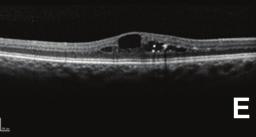 (c)oct of the right eye on clinic visit following a course of three intravitreal bevacizumab