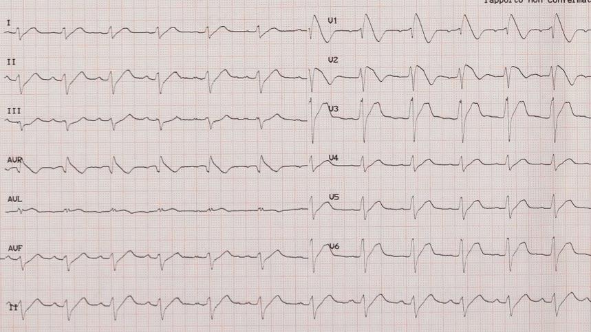 Brugada syndrome: diagnosis J point 2mm Channelopathy characterized by: Coved type ST Genetic segment mutations: elevationna + channel in 15-30% of