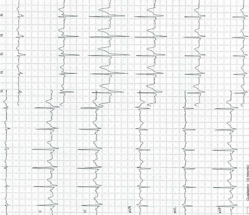 12-lead Holter ECG: