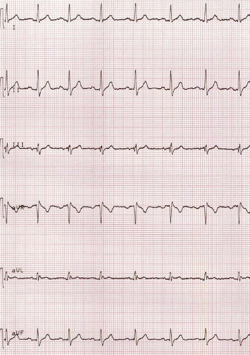 A 45 years old man: traumatic syncope, which