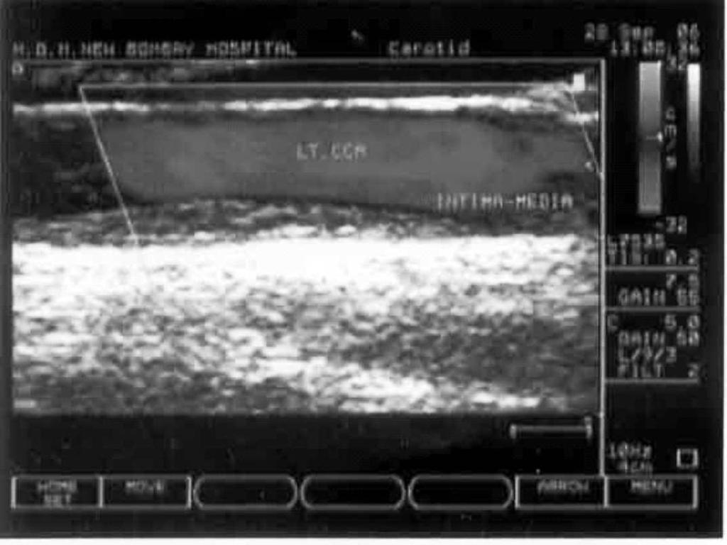 in Diabetology Abstract Non Invasive assessment techniques of atherosclerosis include Pulse-wave velocity at the brachial artery, Intima media thickness (IMT) in the carotid artery, Multi (64)-slice