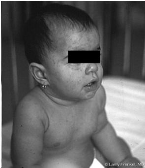 Case #5 A 13-month-old female developed high fever that persisted for 4 days without recognized cause.