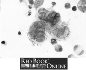 Diagnosis of Herpesviruses Case #1 Isolation virus through culture and/or detection of viral genes or gene products Direct visualization Serology
