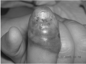 You notice multiple fluidfilled lesions on the finger, as well as some small ulcers on her tongue and bleeding around her gums.