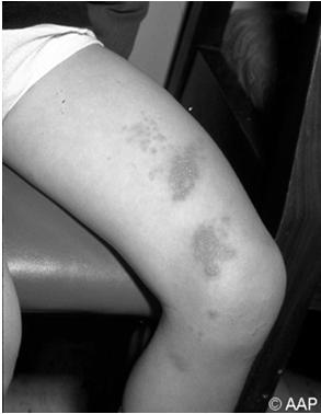 appearance of vesicular rash Varicella-Zoster Virus Transmission: direct contact or aerosol