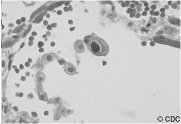 CMV Immunocompromised Hosts Arthralgia Leukopenia Pneumonitis Retinitis Enterocolitis Polyradiculopathy Deterioration of graft function Case