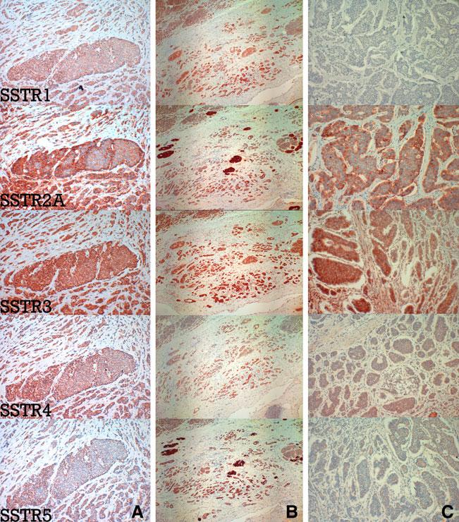 Fig. 2 Immunohistochemical localization of SSTR1 5 (red). a Lymph node metastasis. b Neuroendocrine carcinoma of the terminal ileum. c Neuroendocrine carcinoma of the pancreas head.
