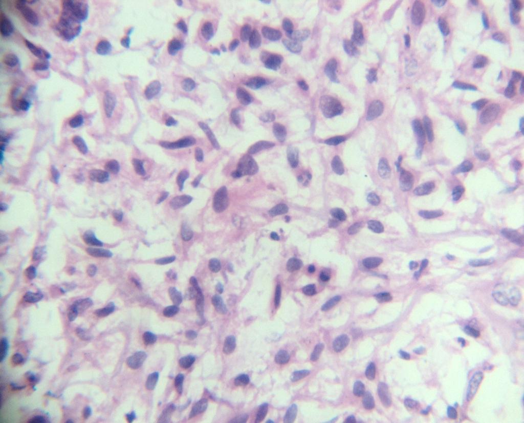 57% Total 28 100 Figure-1: Photomicrograph showing tumour cells arranged in a fascicular pattern High grade TCC (Sarcomatoid variant with squamous differentiation).