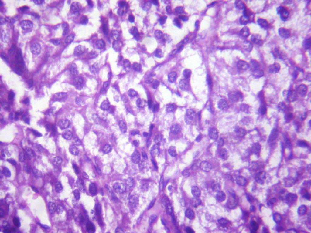 Figure-2: Photomicrograph showing malignant spindle cells. High grade TCC (Sarcomatoid variant with squamous differentiation).