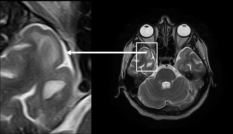 32 Figure 3. MRI of the brain on admission.
