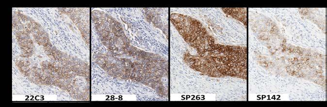 PD-L1 IHC assays for lung cancer: results from phase 1 of the Blueprint PD-L1 assay comparison project