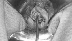 lymphadenectomy Fertility-sparing surgery Radical trachelectomy Removal of cervix, upper vagina and
