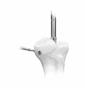 If a significant bone graft was used, a period of time with limited activity is advised to allow the graft to incorporate prior to full loading.