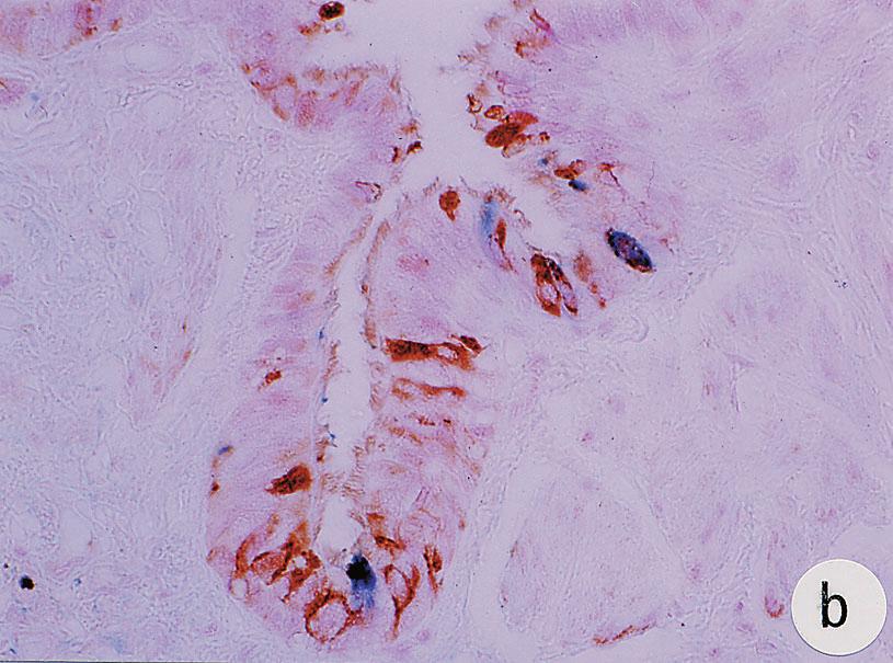 non-ciliated columnar epithelial cells co-expressed CC10 and SP-A in the honeycomb lesion.