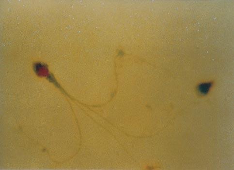 Note the hypoplasia (small arrows) and fragility of acrosome, indicating the existence of abnormal remodelling patterns during spermiogenesis. (Original magnification, 10 000). Figure 2.