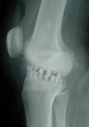 OPIS PROBLEMA -VPRAŠANJE Osteoartroza (OA) kolena je eden med najpogostejšimi vzroki bolečin, zmanjšanja funkcije in potrebe po artroplastiki kolenskega sklepa Simptomi sta bolečina in motena