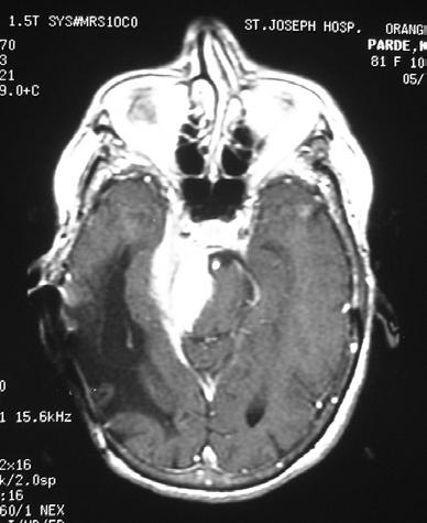 petroclival meningioma First resection: