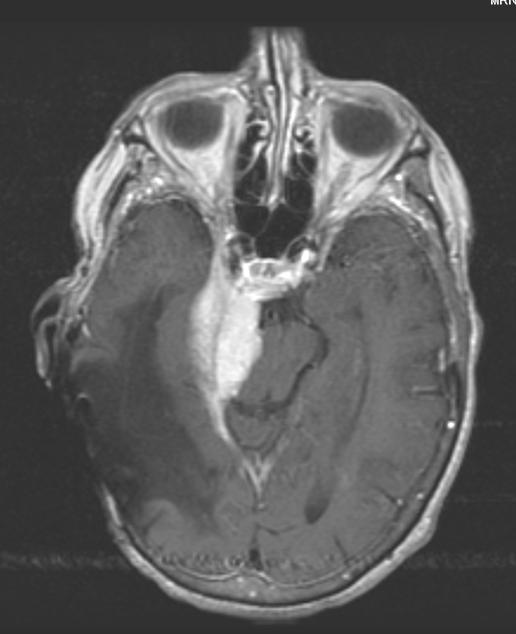 numbness hearing loss MRI Fup: tumor