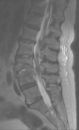 Chronic osteomyelitis in the spine Patient: 75-year old female, abscess formation due to Mycobacterium tuberculosis Operation: April 2009, Helsinki University
