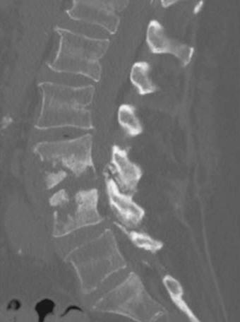 Clinical situation: Posterior decompression LII/ III-LIII/IV, spondylodesis LII-V, lumbotomy, canalisation of paravertebral abscess, resection of LIII, IV,