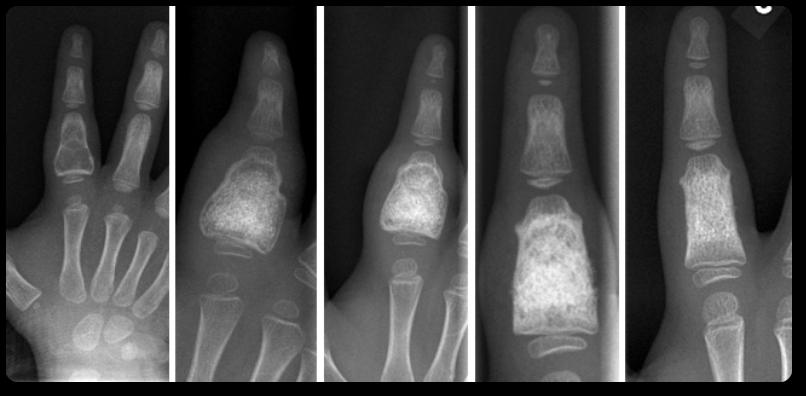 Benign bone tumour in the proximal phalanx in a child CASE Patient was a three year old child with a recurrent aneurysmal bone cyst of the proximal phalanx of the index finger.